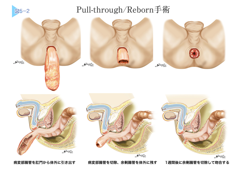 Reborn surgery