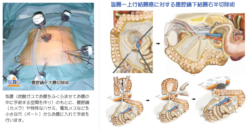 写真3 腹腔鏡下大腸切除術気腹（炭酸ガスでお腹をふくらませてお腹の中に手術する空間を作り）のもとに、腹腔鏡（カメラ）や特殊なハサミ、電気メスなどを小さな穴（ポート）からお腹に入れて手術を行います。  