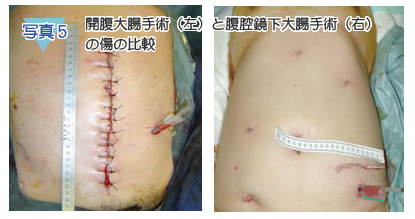 写真5 開腹大腸手術（左）と腹腔鏡下大腸手術（右）の傷の比較 