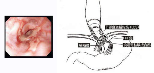 逆流 性 食道 炎 薬