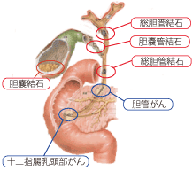 胆石症の腹腔鏡下手術 腹腔鏡下胆のう摘出術などの治療 豊中緑ヶ丘病院