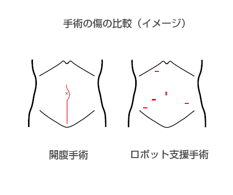 手術の傷の比較イメージ